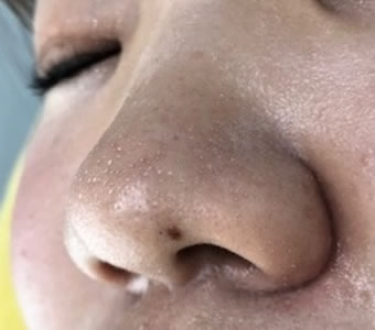 特に小鼻 眉間 アゴは気になる箇所